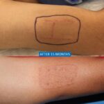 Treatment of self-harm scars