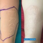 Scars on arm removal
