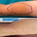Skin graft for self-harm scars