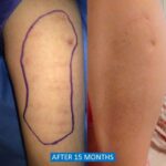 Self-harm scar removal before after