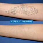 Scar removal surgery