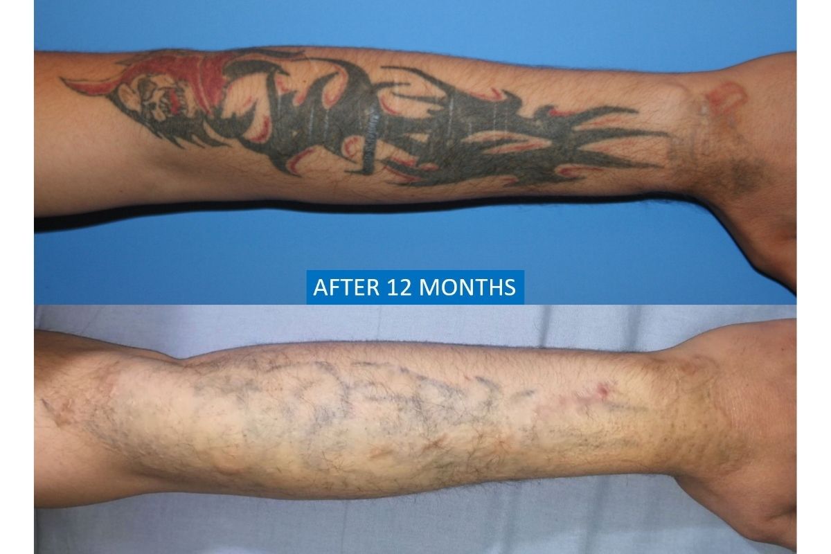 Skin grafting tattoo removal