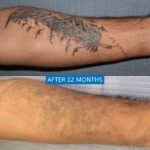 Scars and tattoo removal before after