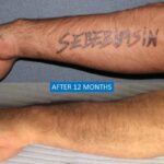 Tattoo removal with skin graft before after