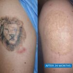 Treatment of Tattoo and Scars on arm