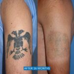 Tattoo and Self-harm scar removal before after