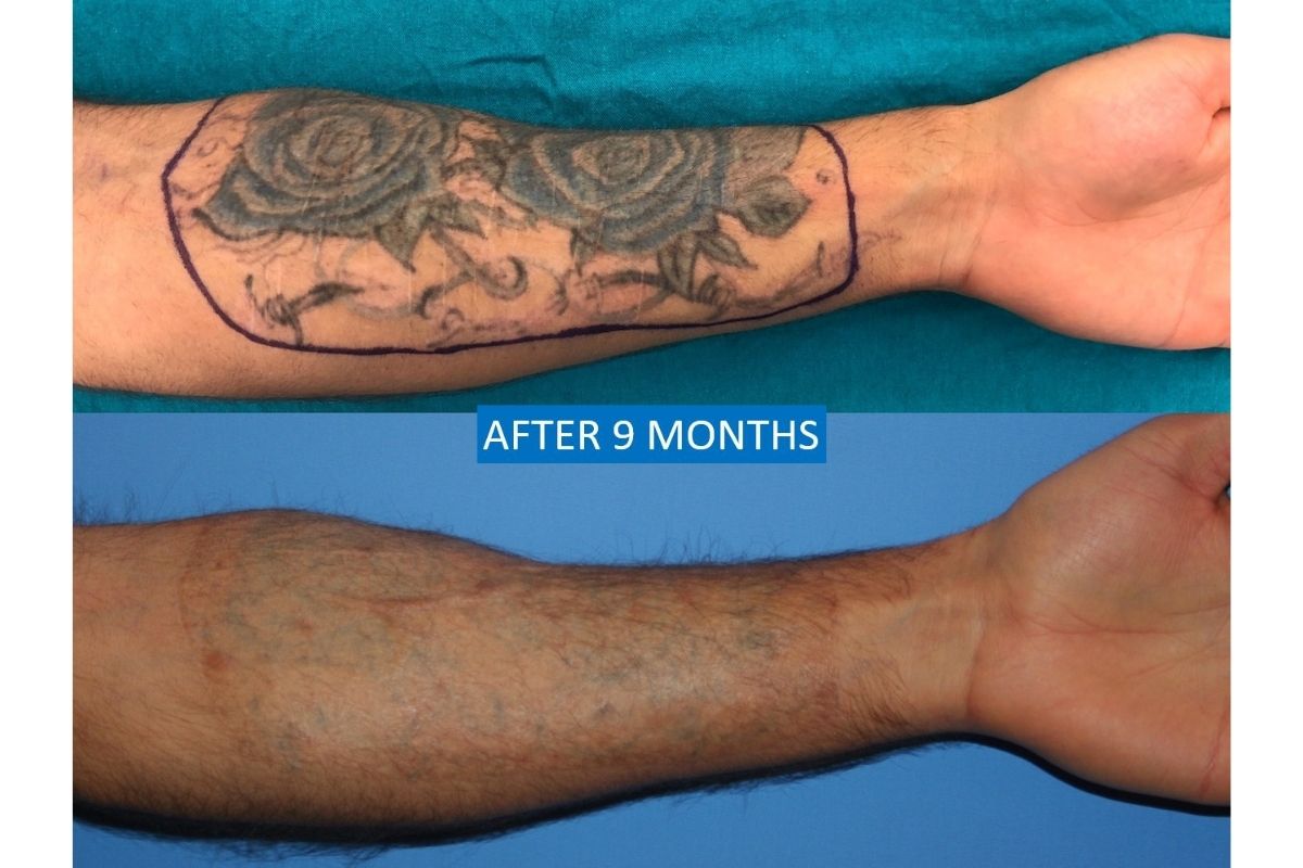 Cover up Tattoo Scars Before & After Photos - Arm Scars