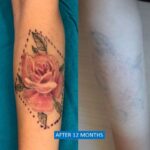 Self-harm scar treatment and tattoo removal before after