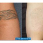 Treatment of self-harm scars and tattoo