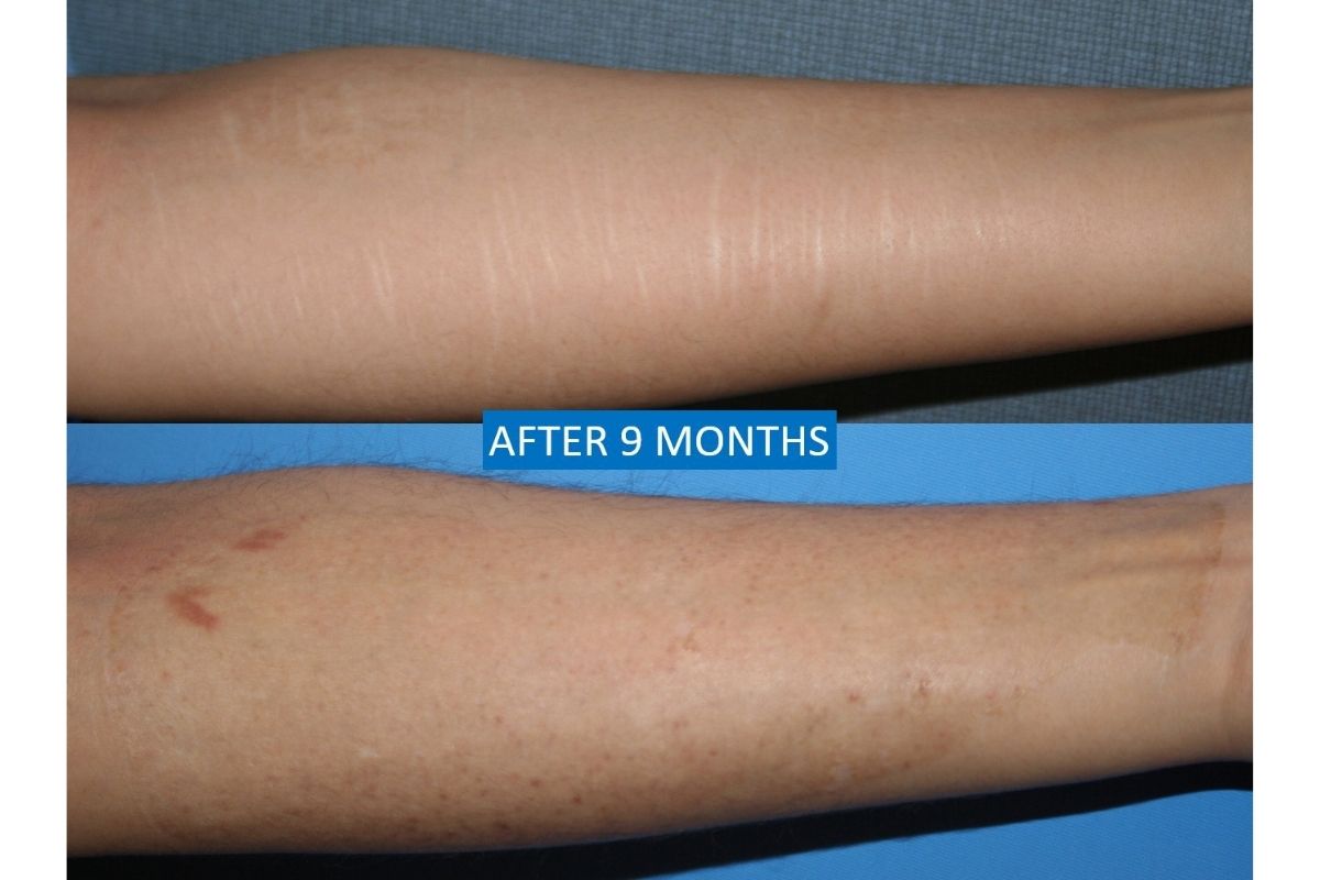 Scars on arm removal