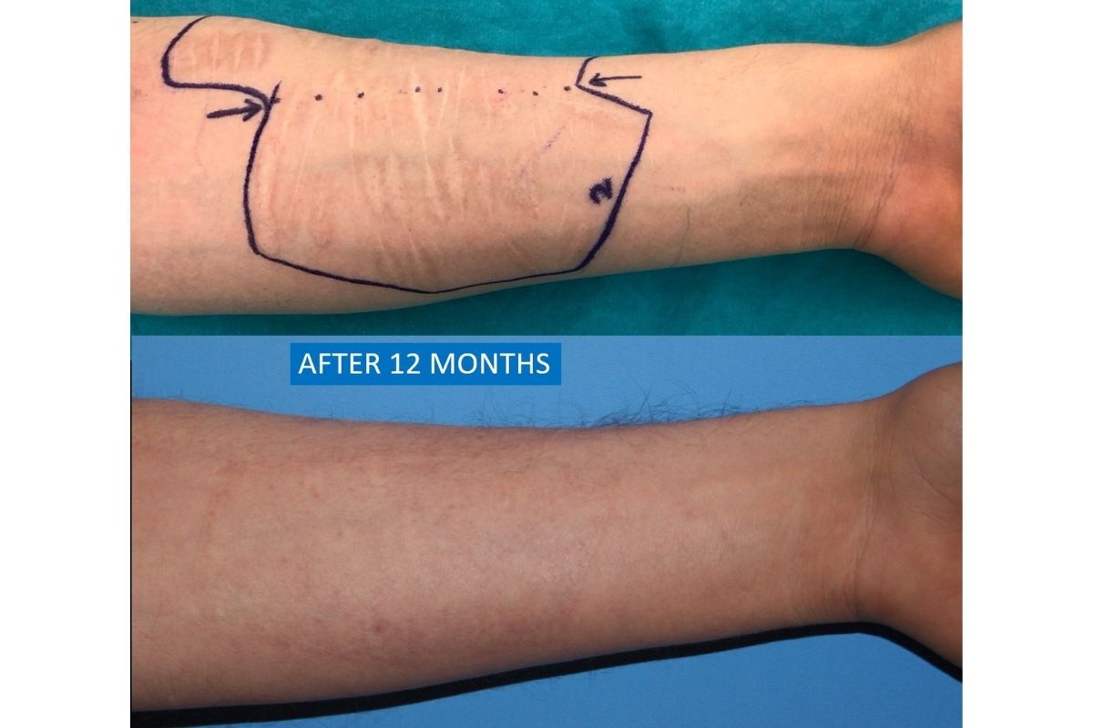 Self-inflicted scar removal before after