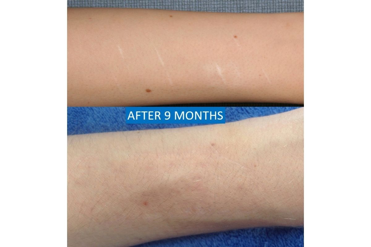 Self-inflicted scar treatment before after