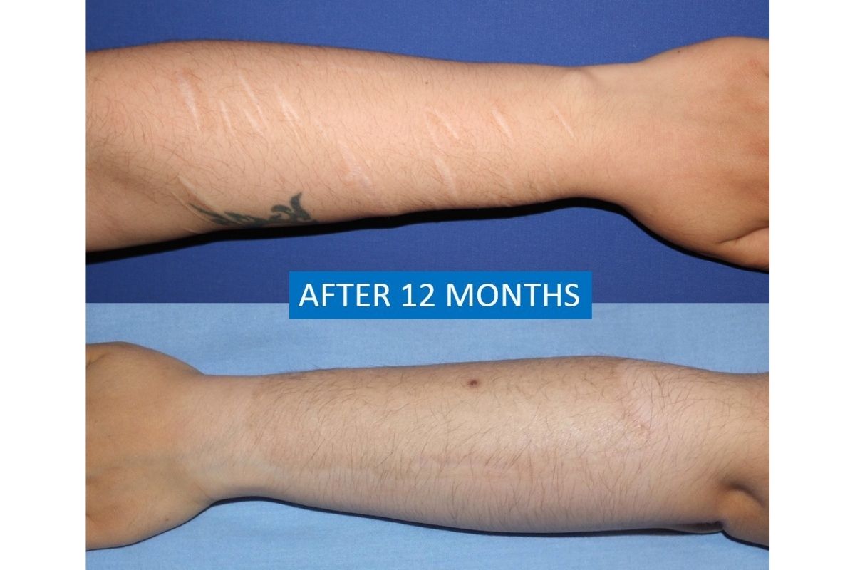 Self-harm scar removal before after