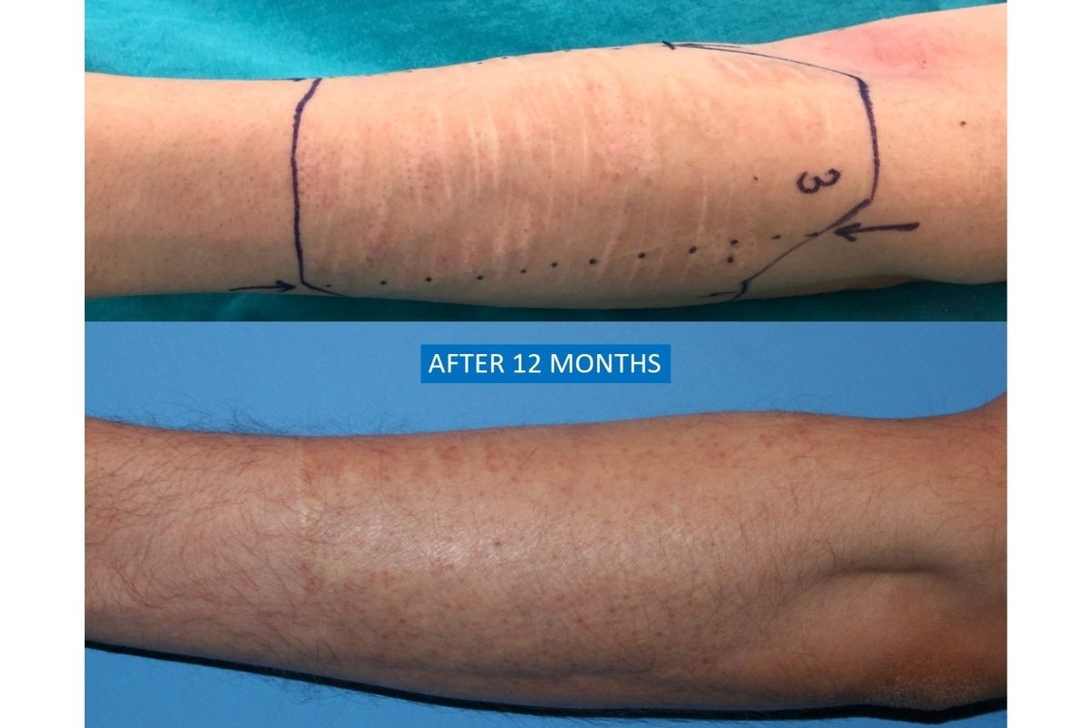 Self-inflicted scar treatment before after