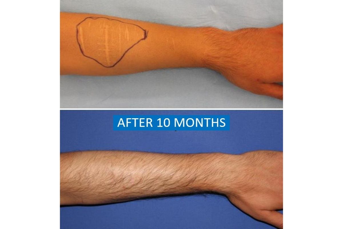 Dermabrasion and Skin graft for self-harm scars