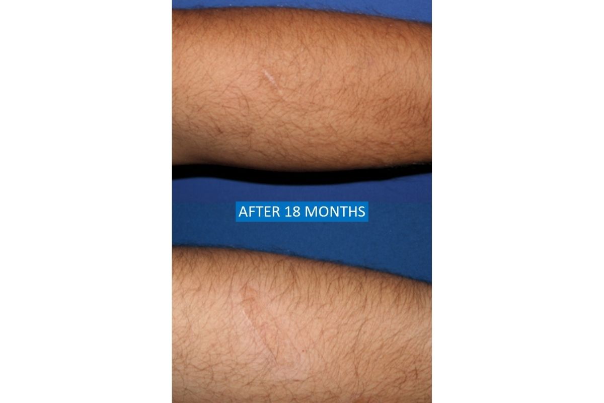 Skin graft for self-harm scars