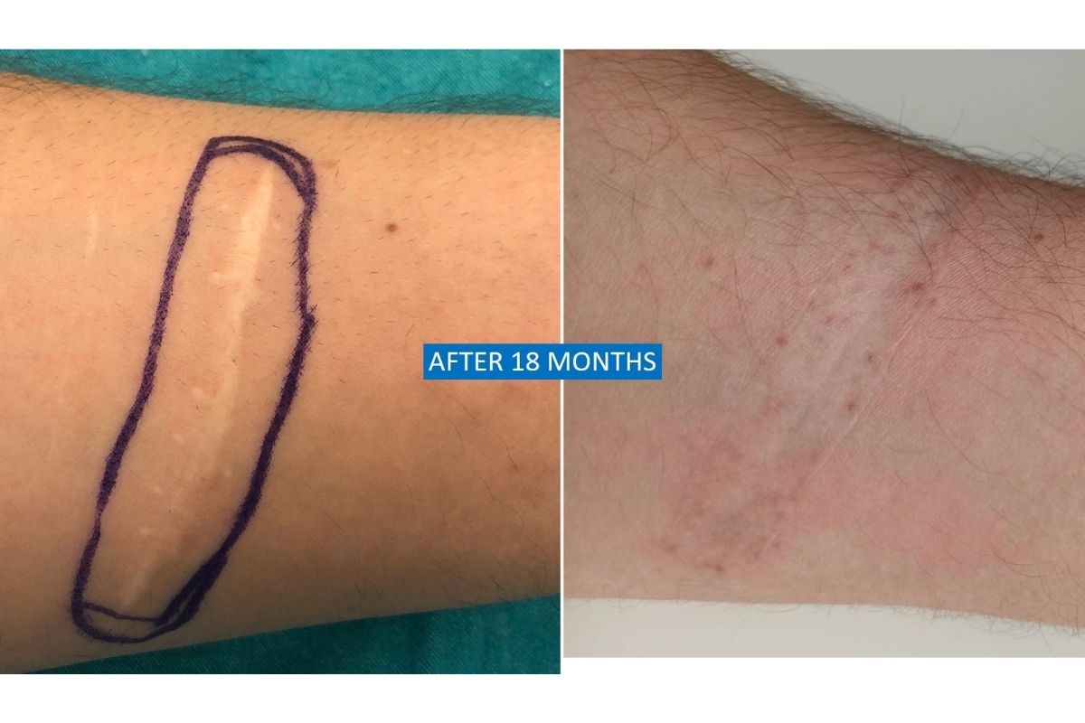 Scar treatment before after