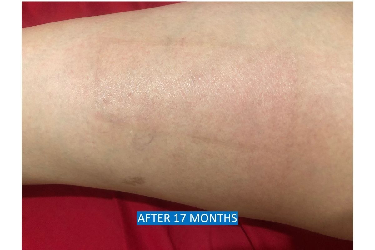 Skin graft donor scar on thigh