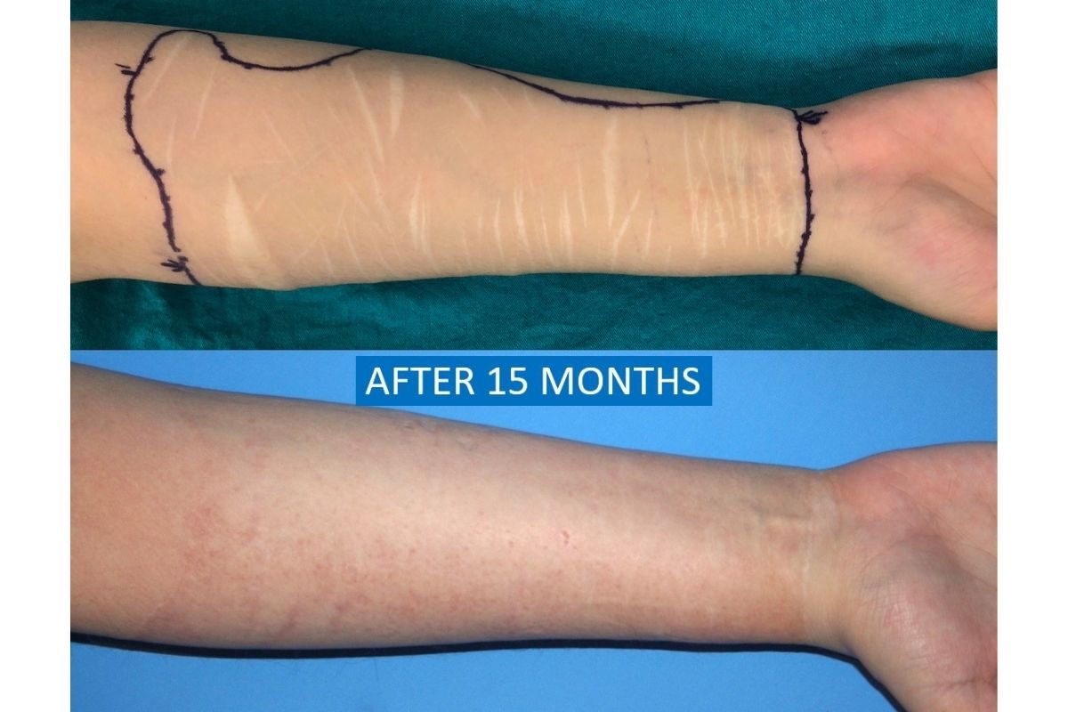 Self-harm scar treatment with thin skin graft