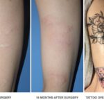 Camuflage of self-harm scar by thin skin graft and tattoo