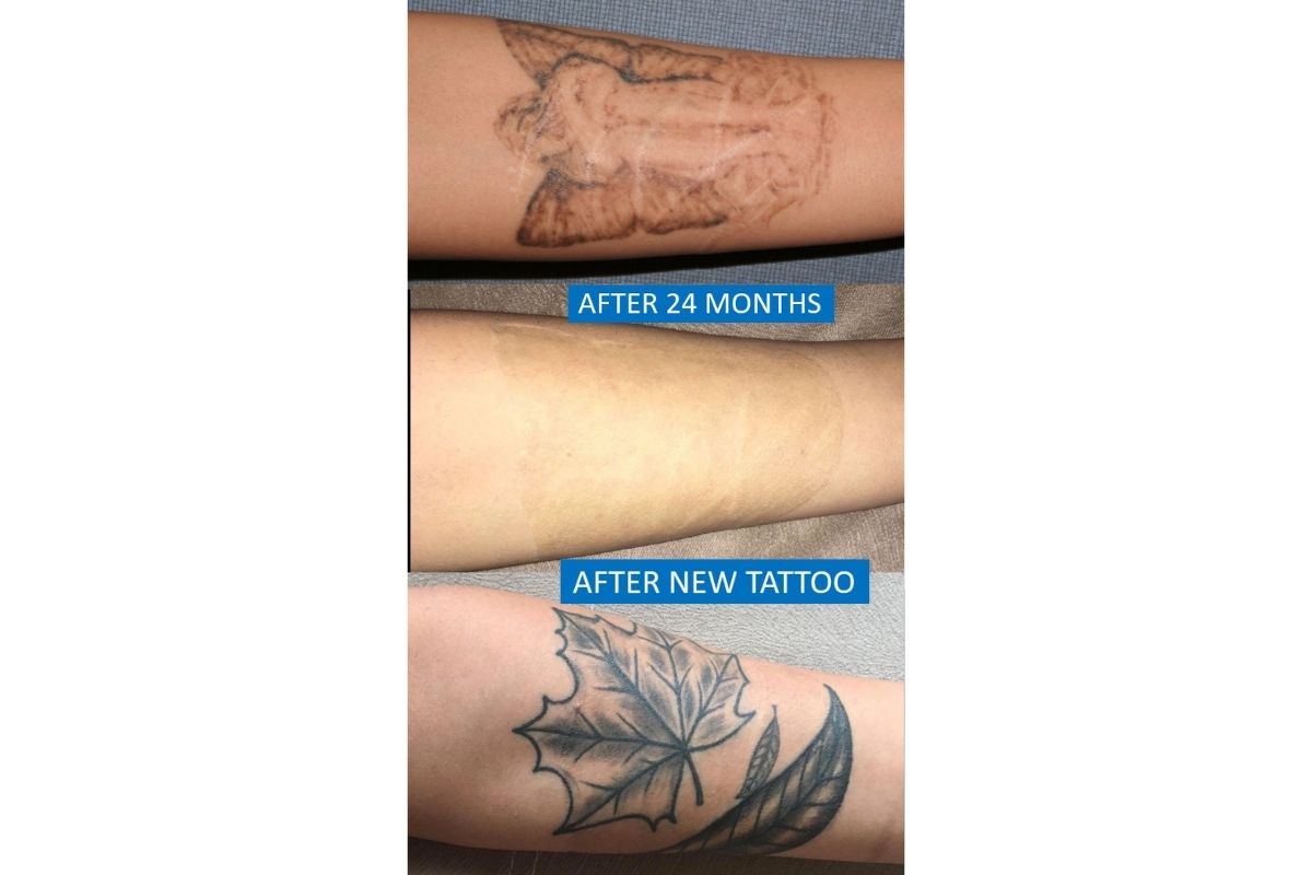Tattoo over skin graft 2